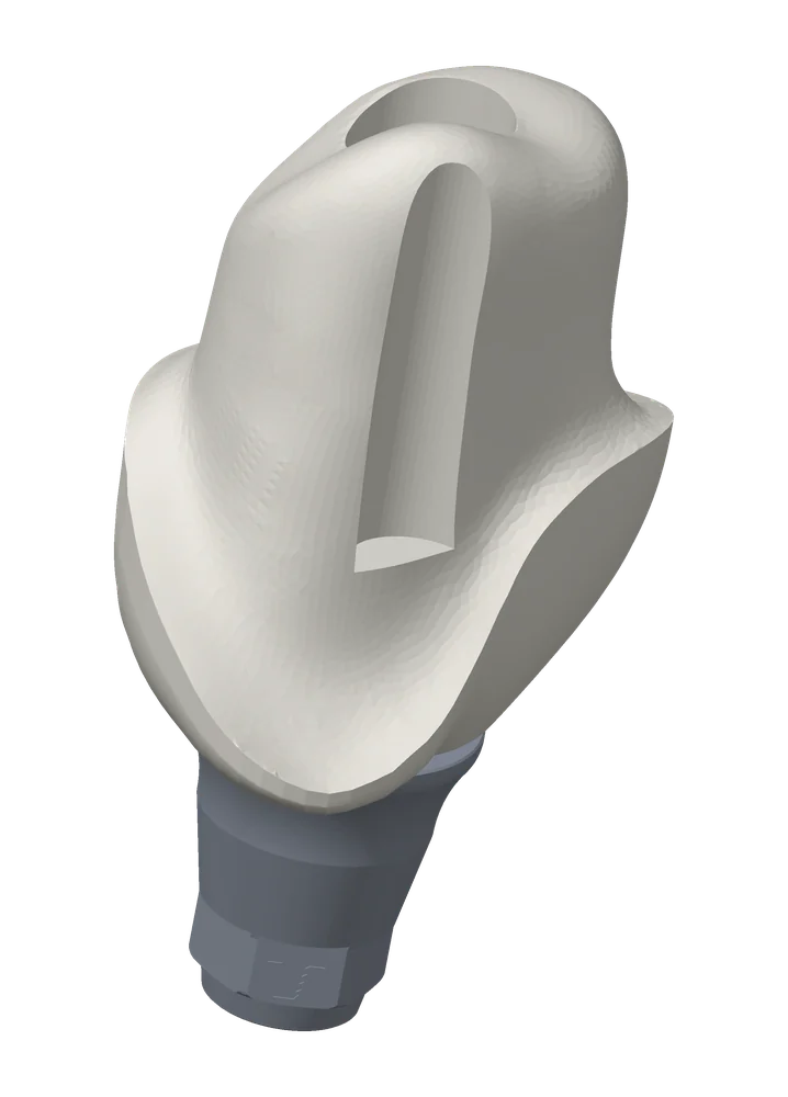 Final abutment seen from the buccal: zirconia shaped like a prepped tooth on its engaging titanium base, screw access channel open