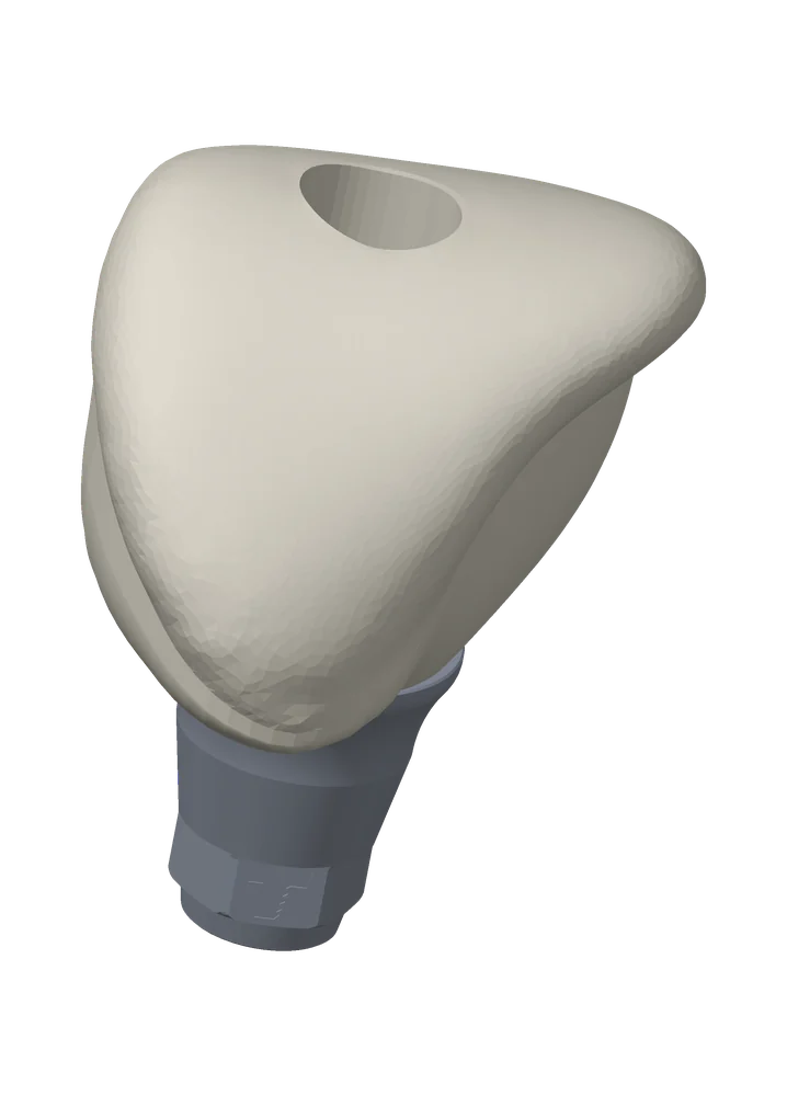 Custom PMMA healing abutment seen from the buccal, its anatomic emergence profile flaring above the engaging titanium base
